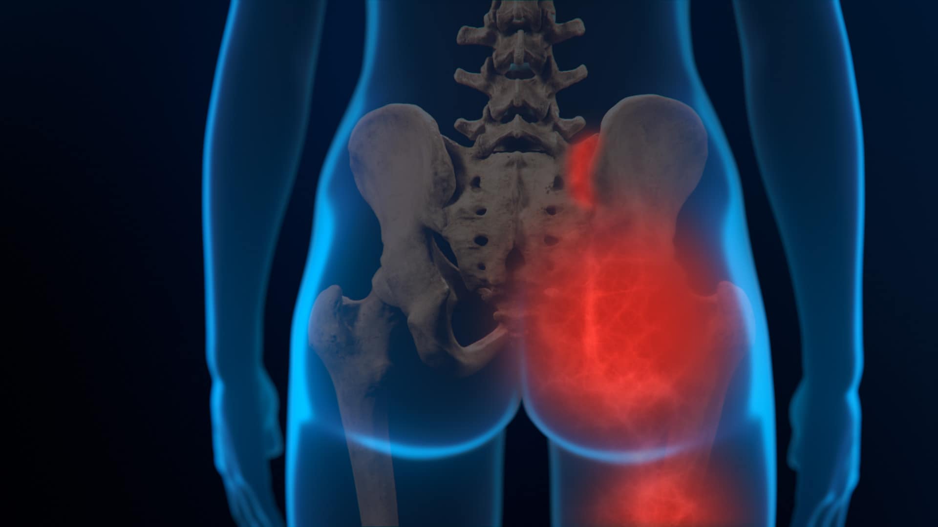 Dolor en la articulación SI