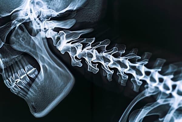 subluxación de la columna vertebral
