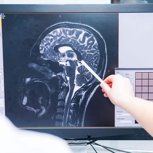 Abogados especializados en lesiones cerebrales: lesiones cerebrales traumáticas