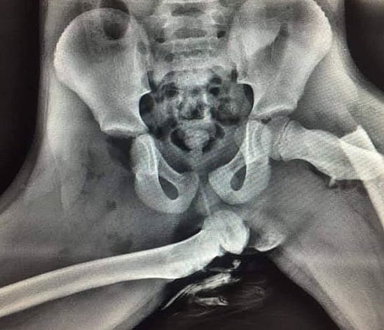 X-Ray of Injuries From Riding With Your Feet on the Dashboard in a Crash - Audra Tatum of Chickamauga, Georgia. X-Ray Reveals Injuries Sustained by Audra Tatum From Resting Her Feet on the Dashboard During a Car Accident