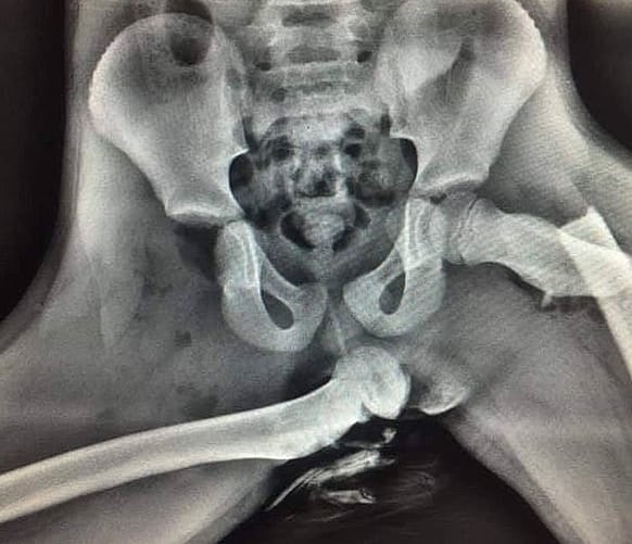 Radiografía de las lesiones por ir con los pies en el salpicadero en un accidente - Audra Tatum de Chickamauga, Georgia. Las radiografías revelan las lesiones sufridas por Audra Tatum al apoyar los pies en el salpicadero durante un accidente de coche